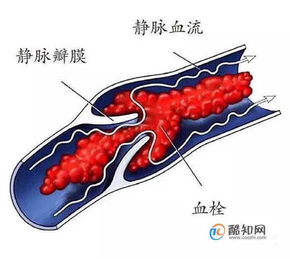 长期久坐会得肺栓噻？