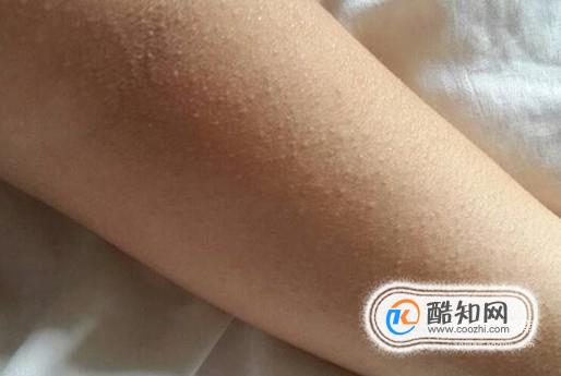 天气这么热, 长了痱子怎么办