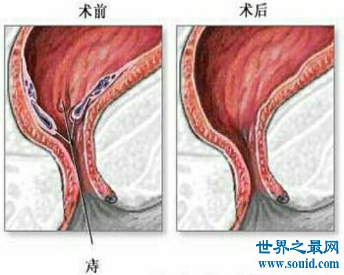 痔疮是一种非常痛苦的疾病 痔疮的症状是什么呢