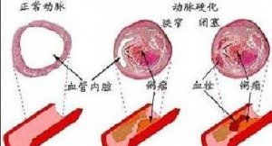 心血管疾病吸烟能引发这种病戒烟从你我开始