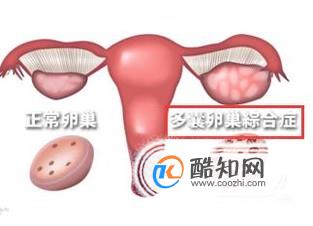 患有多卵巢综合症饮食上要注意什么