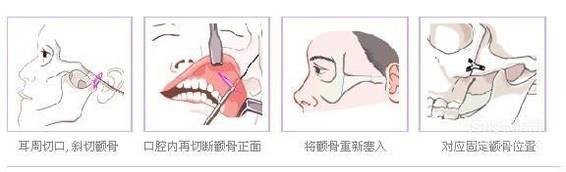 磨颧骨手术效果好不好？