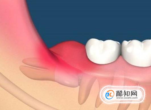 长出智齿了怎么办？什么样的智齿需要拔掉？