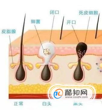 怎样用维生素B6去闭口