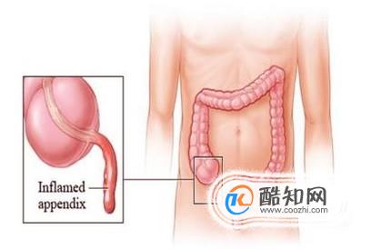 阑尾炎一定要做手术吗？