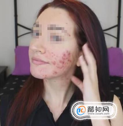 ps怎么去痘痘