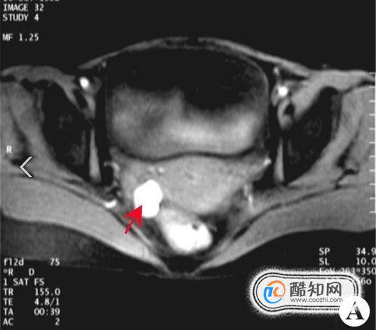 巧克力囊肿严重吗？