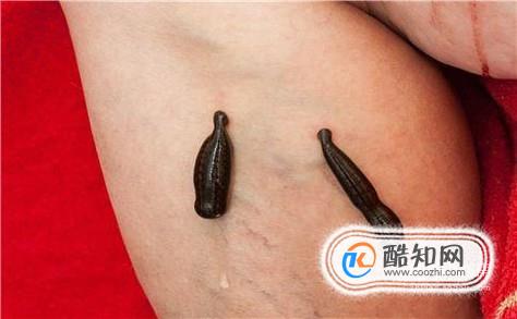 被水蛭（蚂蝗）钻入身体怎么办？
